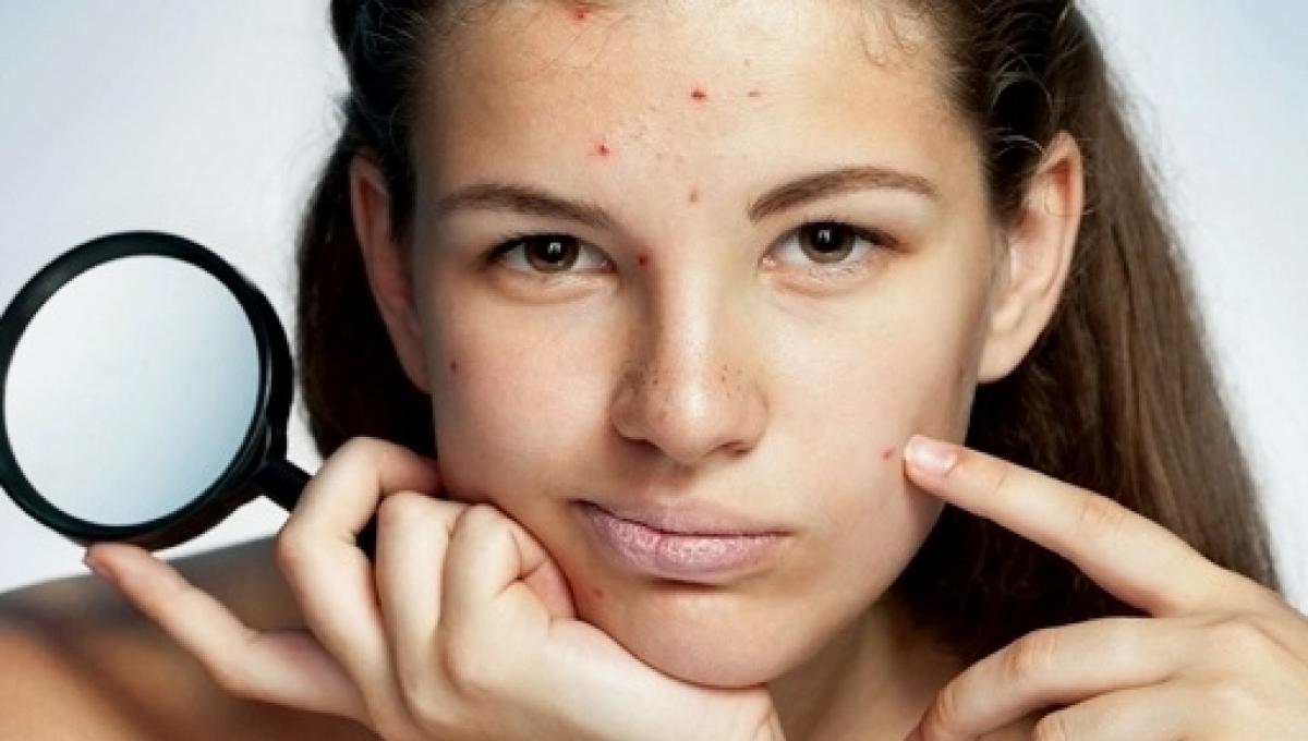 Acne e dieta: c'è un nesso?